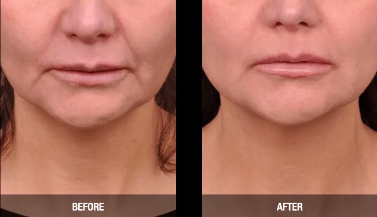 RF before and after results