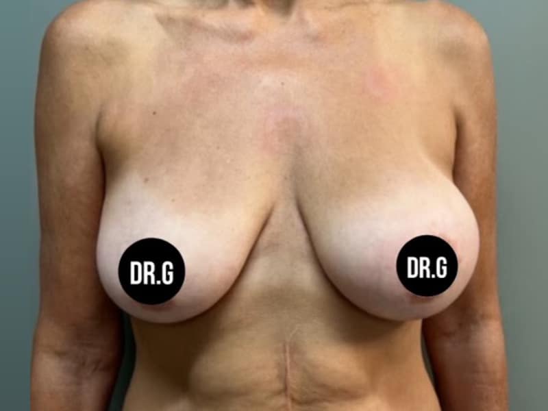 Case--2543 | After Breast Lift