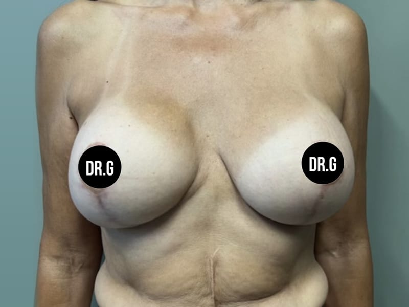 Case--2543 | Before Breast Lift