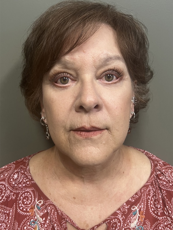 Case--8592 | After Eyelid Surgery