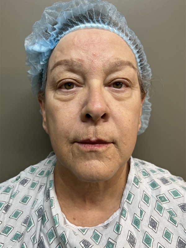 Case--8592 | Before Eyelid Surgery