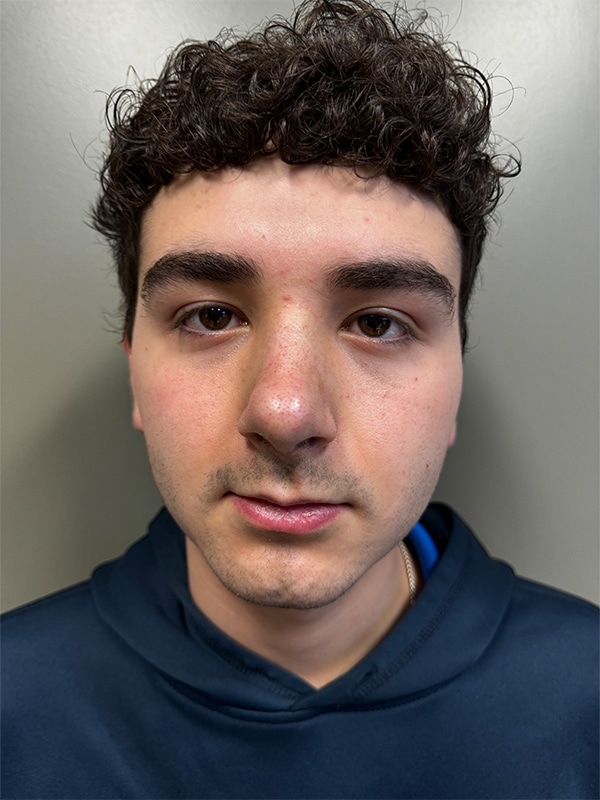 Case--4816 | After Rhinoplasty