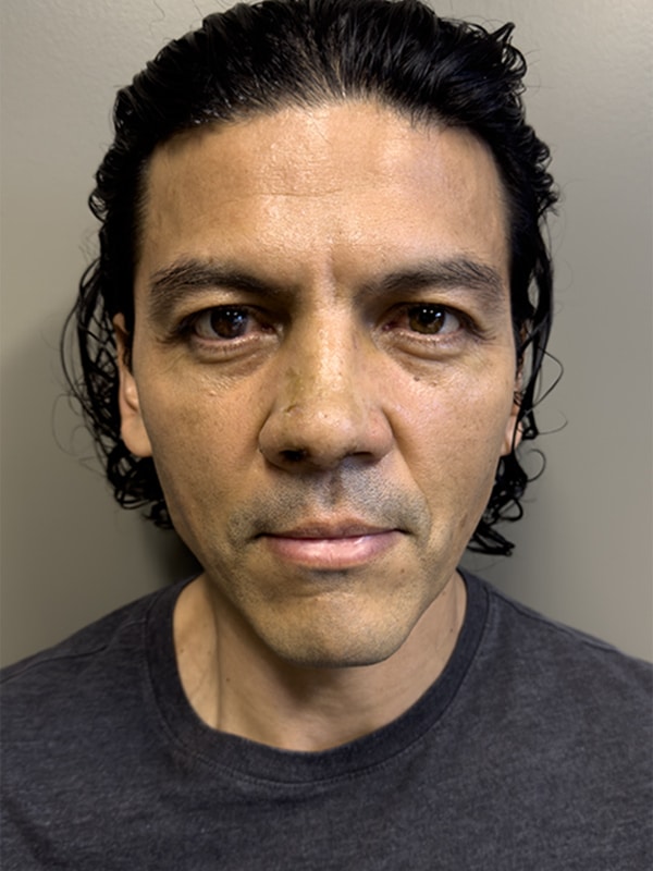 Case--5626 | After Rhinoplasty