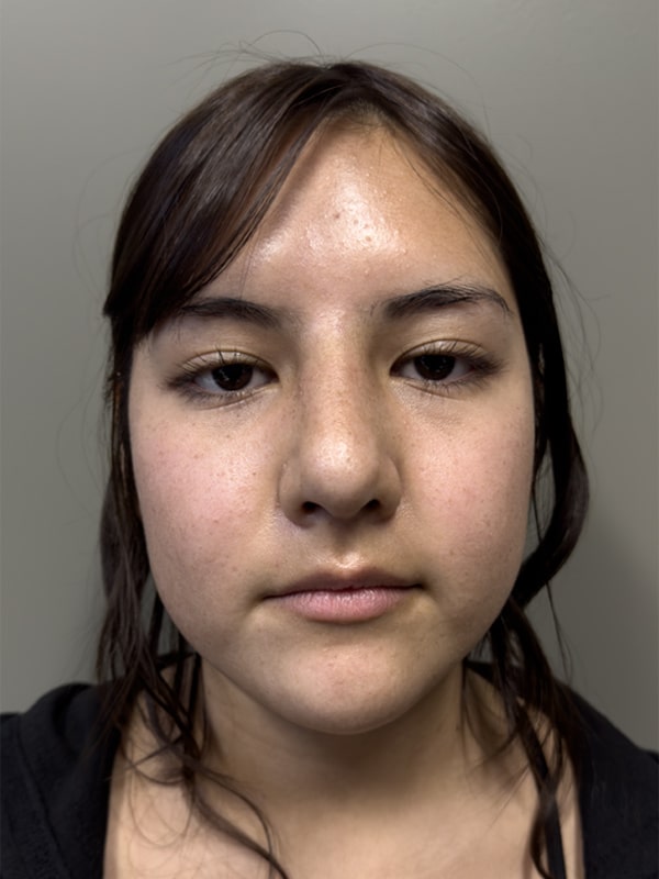 Case--6551 | After Rhinoplasty