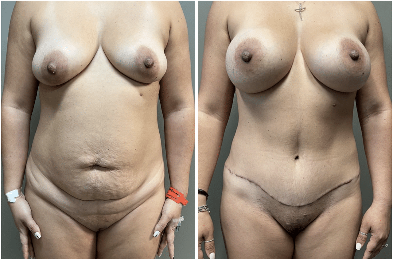 Before and after results