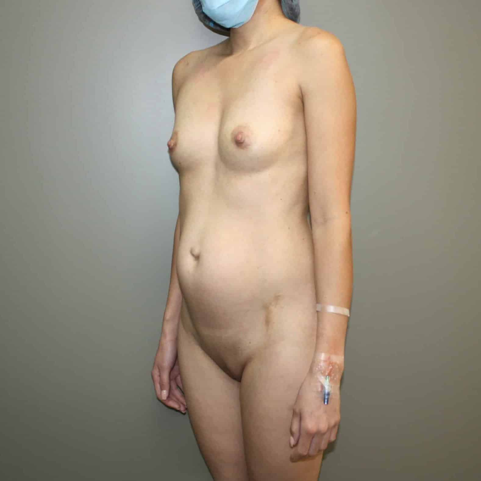 Case--3602 | Before Tummy Tuck