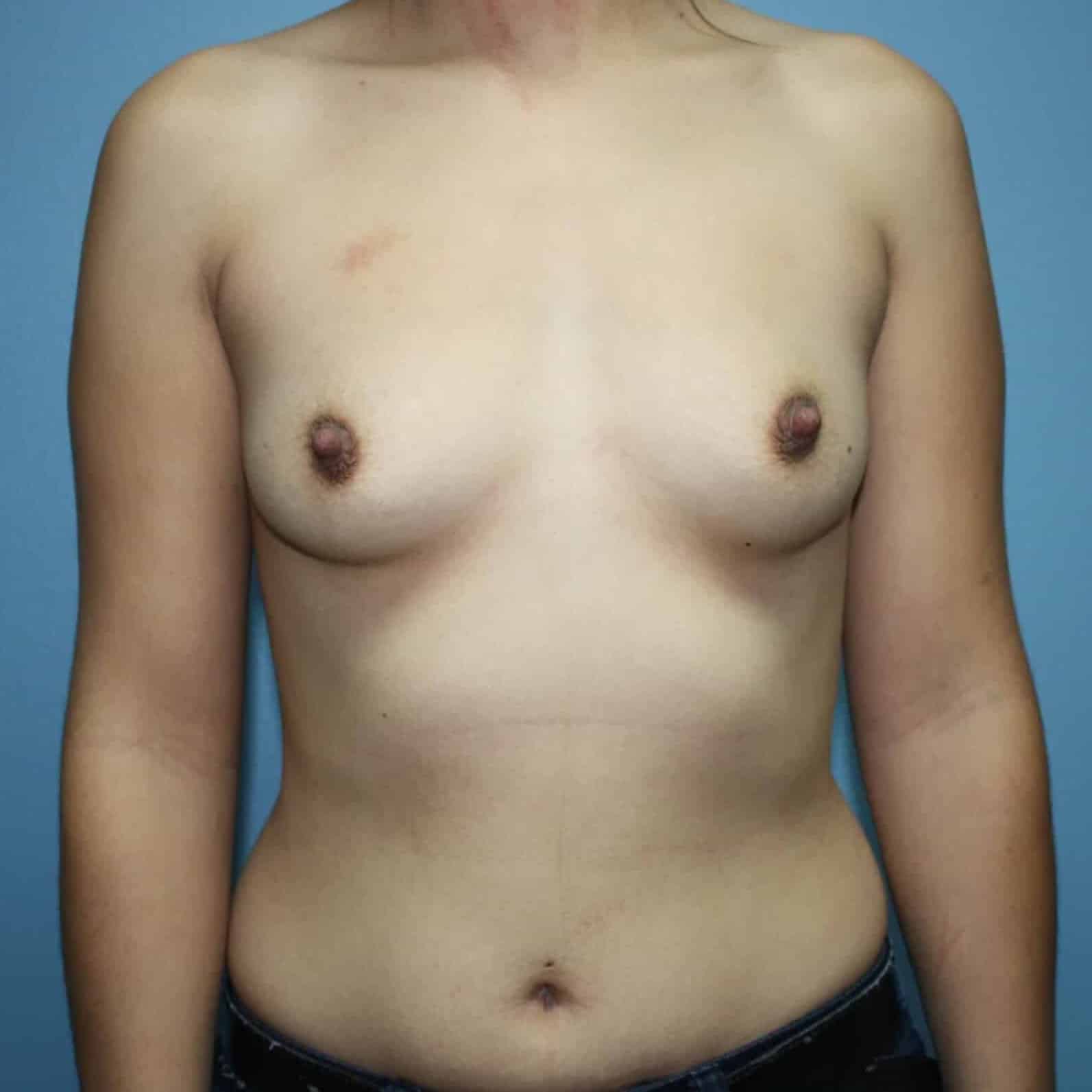 Case--6664 | Before Breast Augmentation