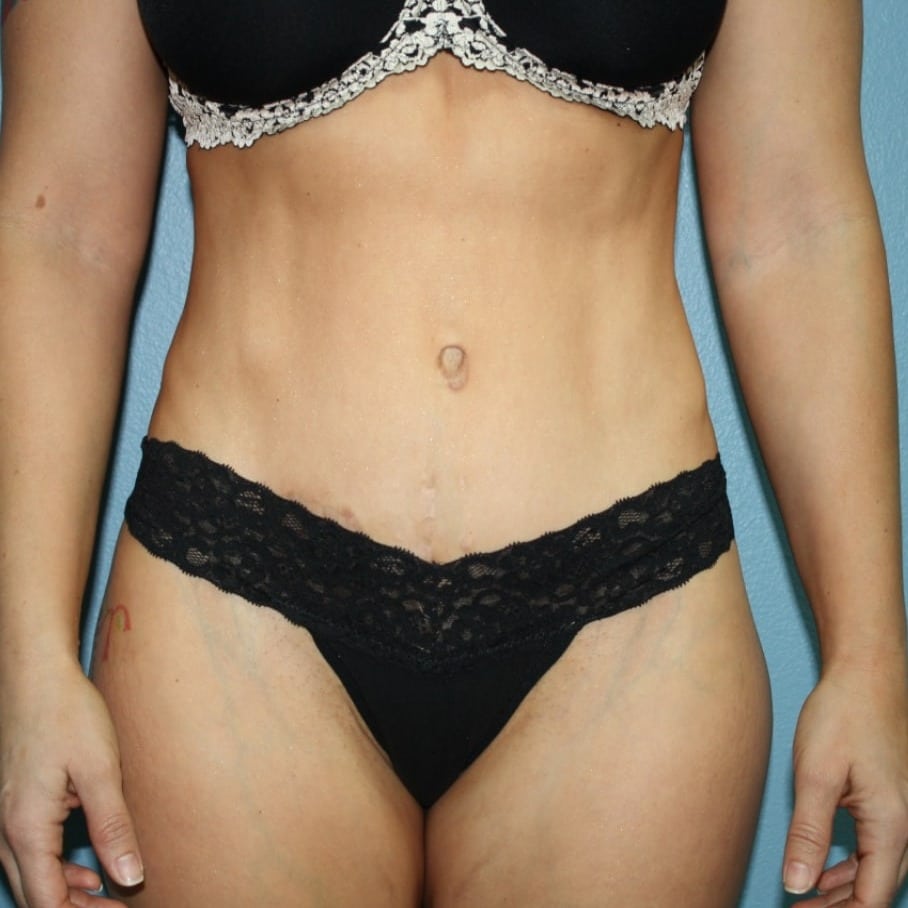 Case--2020 | After Brazilian Butt Lift