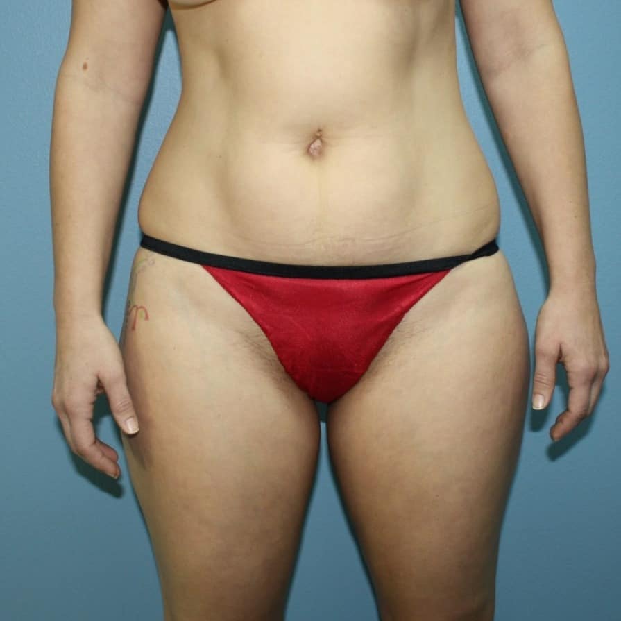 Case--2020 | Before Brazilian Butt Lift