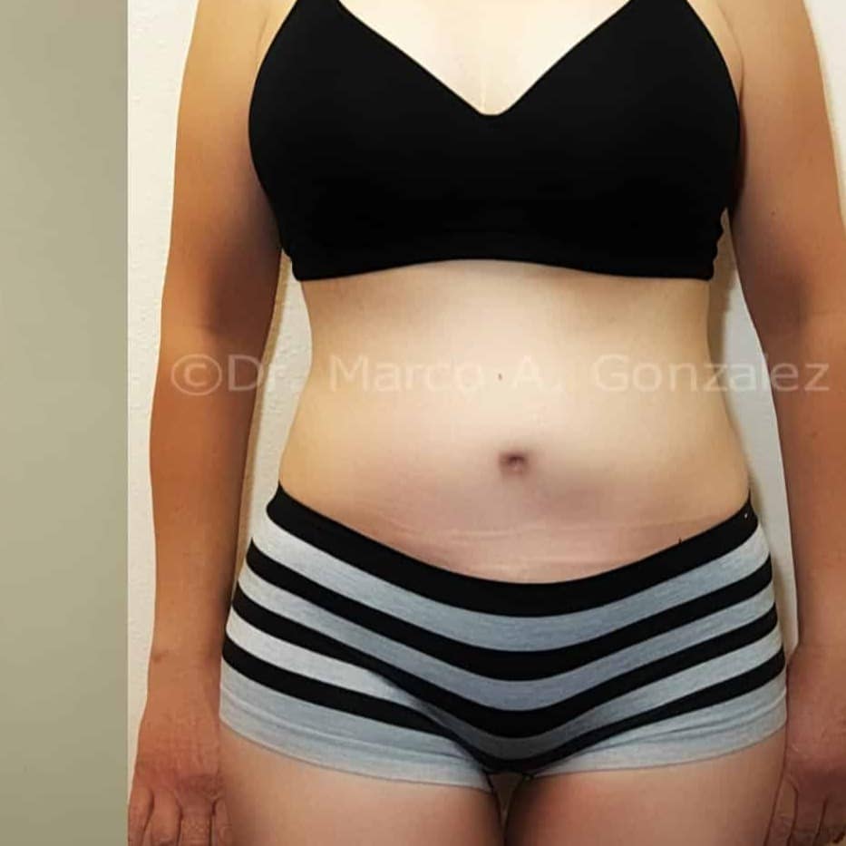 Case--4653 | After Tummy Tuck