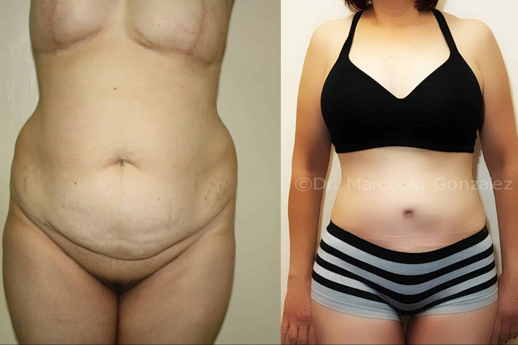 Case--8084 | Before Laser 4D Hi-Def Liposculpting
