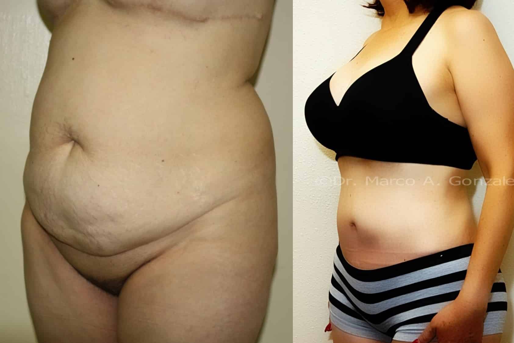 Case--8084 | After Laser 4D Hi-Def Liposculpting