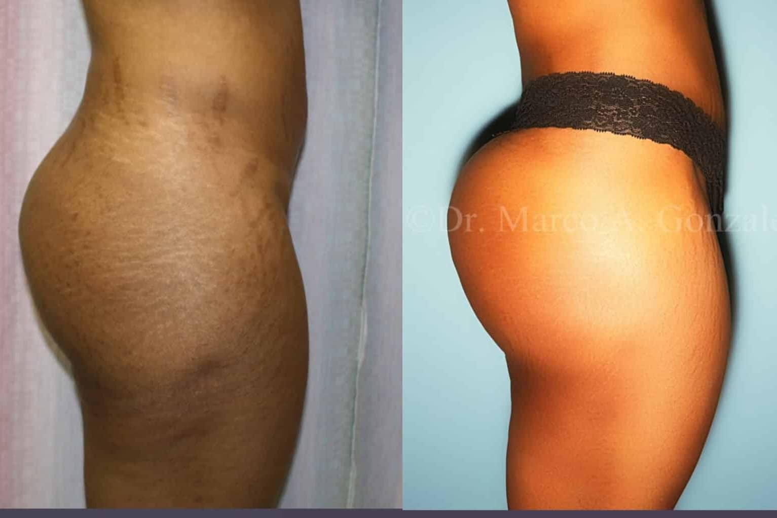 Case--2201 | Before Laser 4D Hi-Def Liposculpting