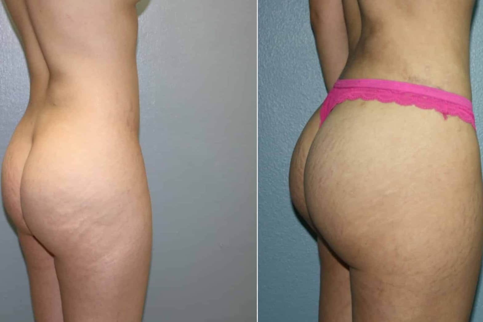 Case--2062 | After Laser 4D Hi-Def Liposculpting