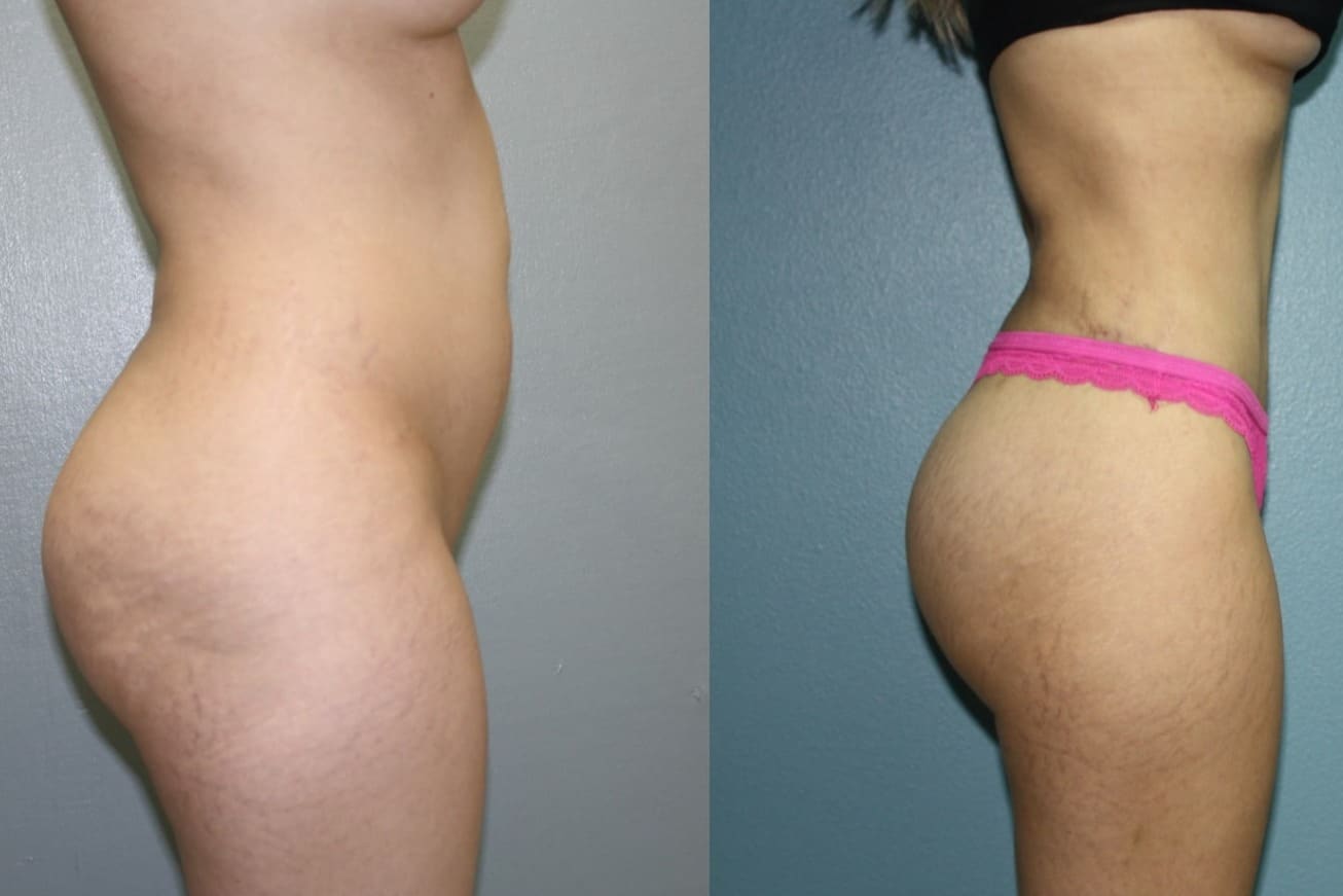 Case--2062 | Before Laser 4D Hi-Def Liposculpting