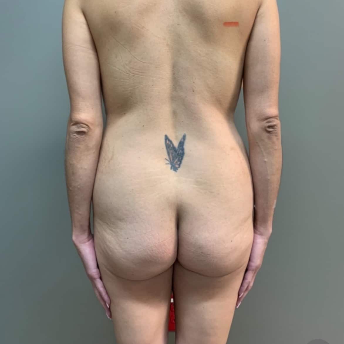 Case--1845 | Before Brazilian Butt Lift