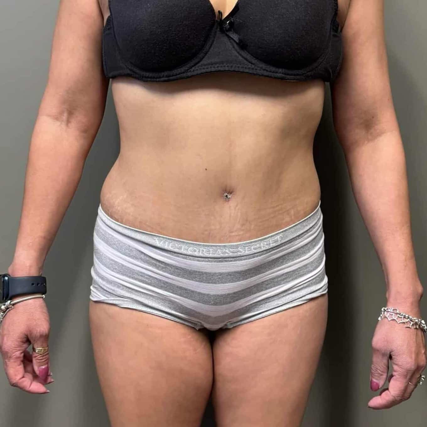 Case--4388 | After Tummy Tuck