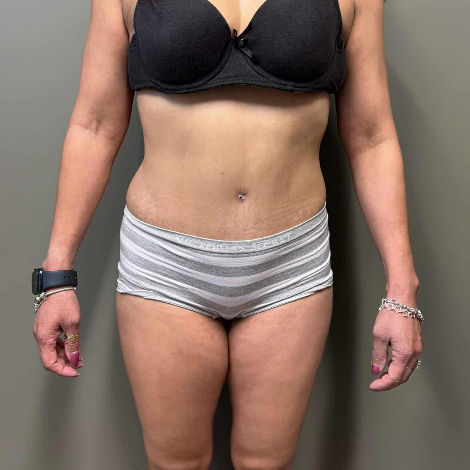 Case--7882 | After Tummy Tuck