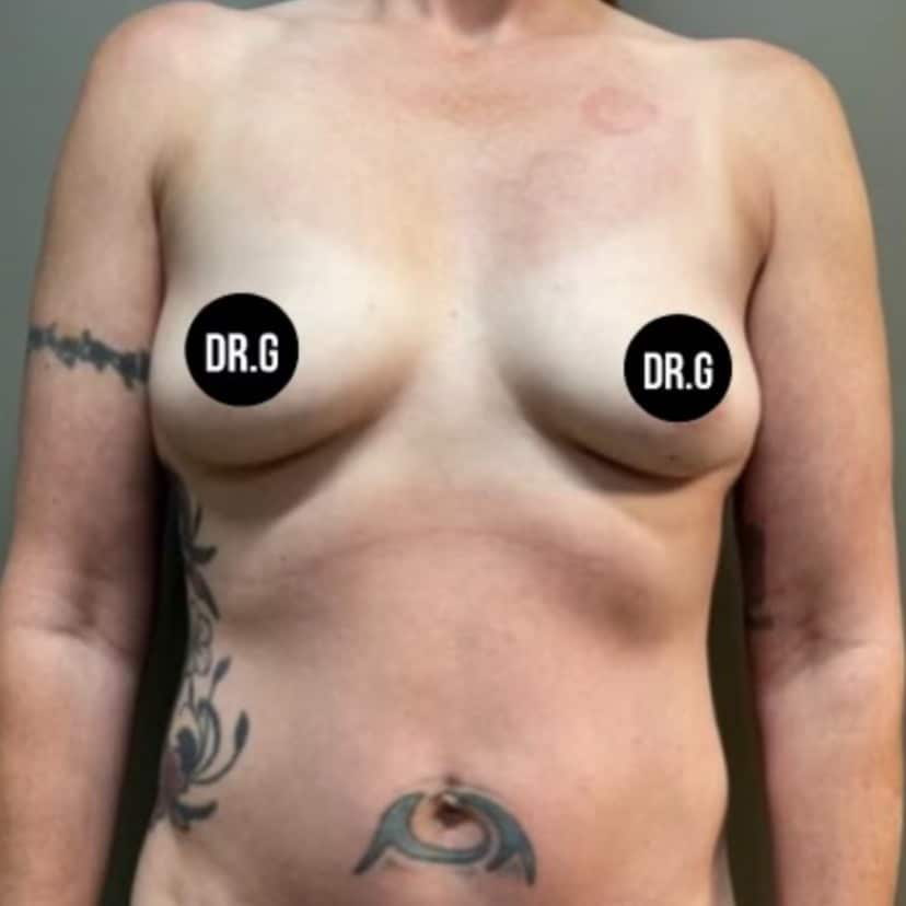 Case--9892 | Before Breast Augmentation