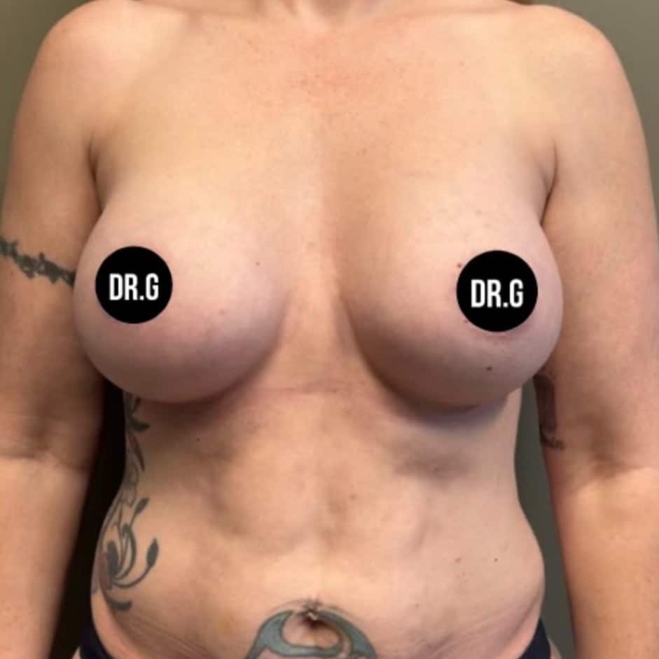 Case--9892 | After Breast Augmentation