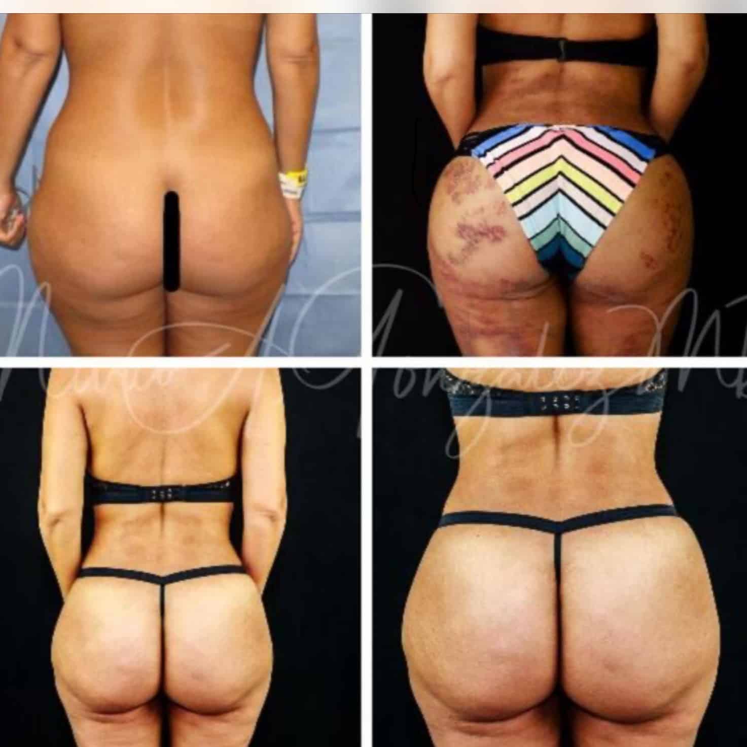 Case--8629 | After Brazilian Butt Lift