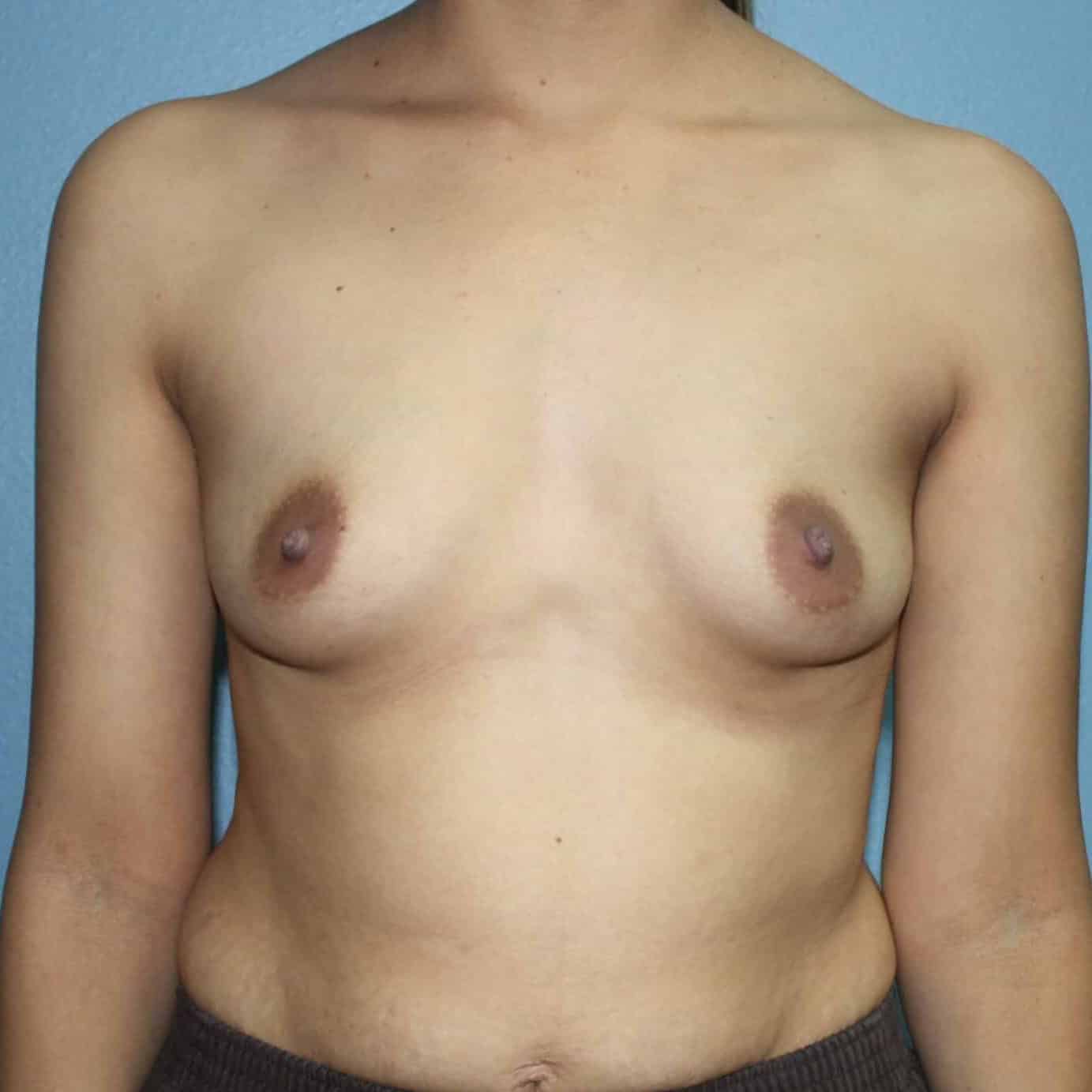 Case--7573 | Before Breast Augmentation