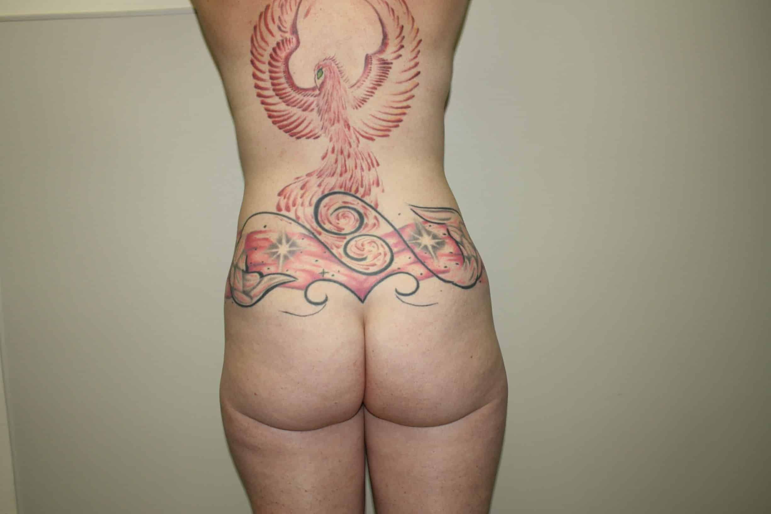 Case--5978 | Before Brazilian Butt Lift