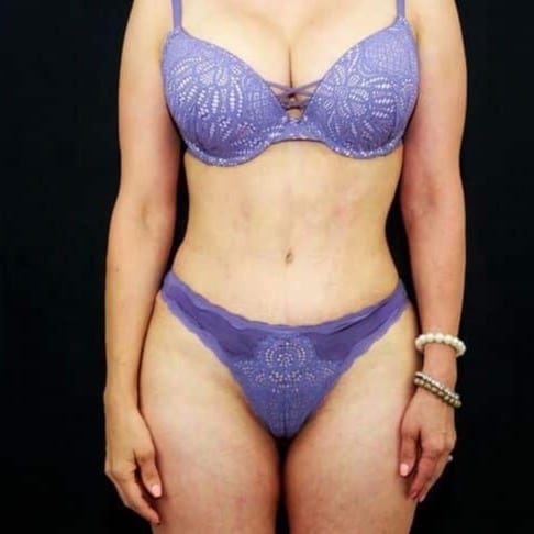 Case--8506 | After Laser 4D Hi-Def Liposculpting