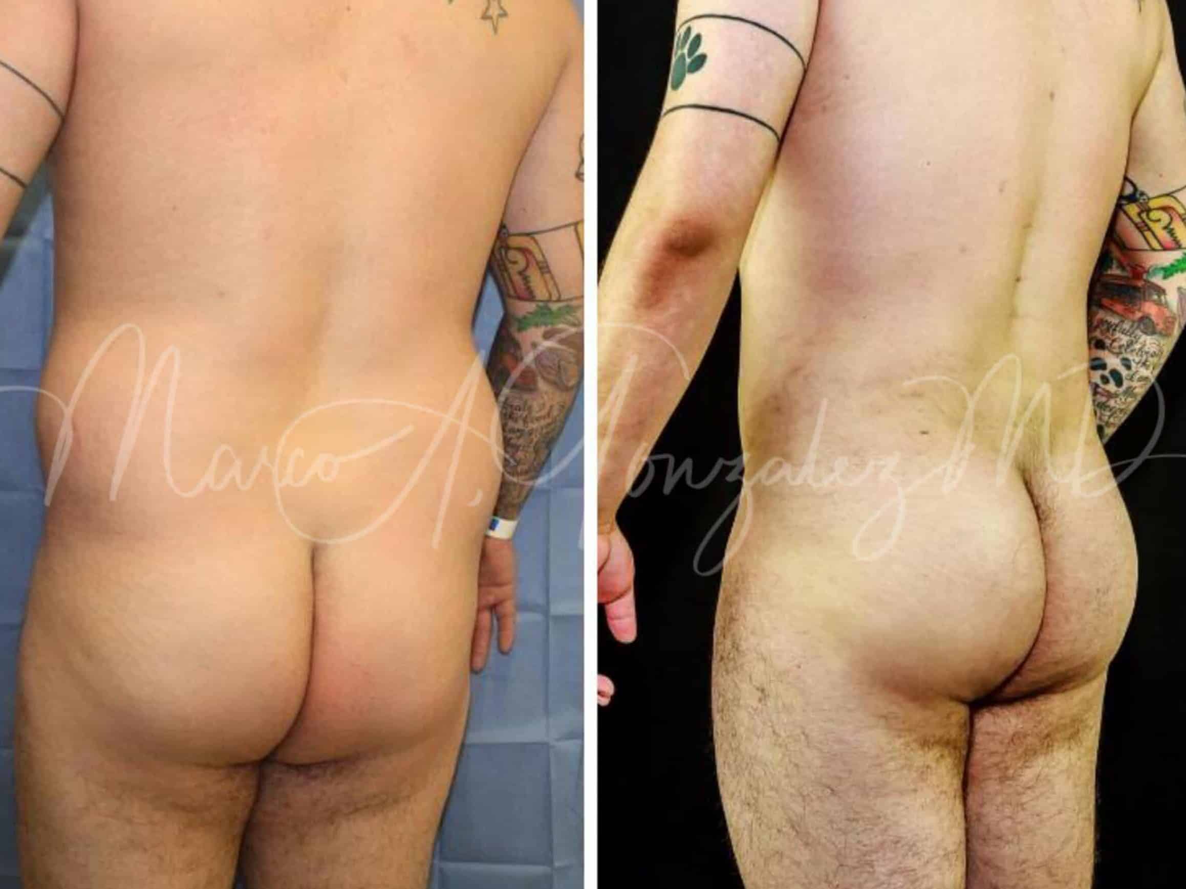 Case--2316 | After Body