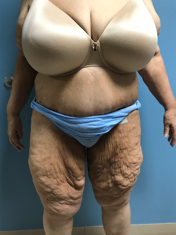 Case--6290 | After Body