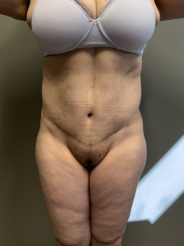 Case--6383 | After Body