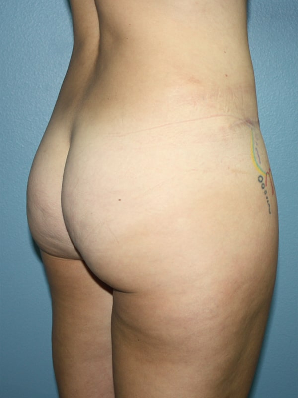 Case--9792 | Before Brazilian Butt Lift