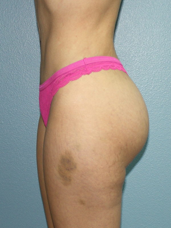 Case--8561 | After Laser 4D Hi-Def Liposculpting