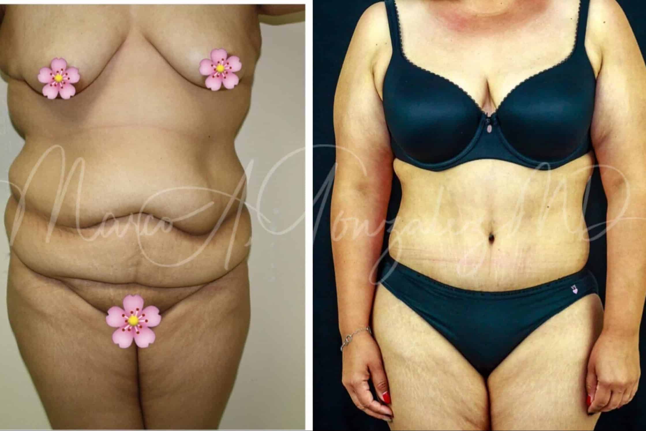 Case--6286 | Before Laser 4D Hi-Def Liposculpting