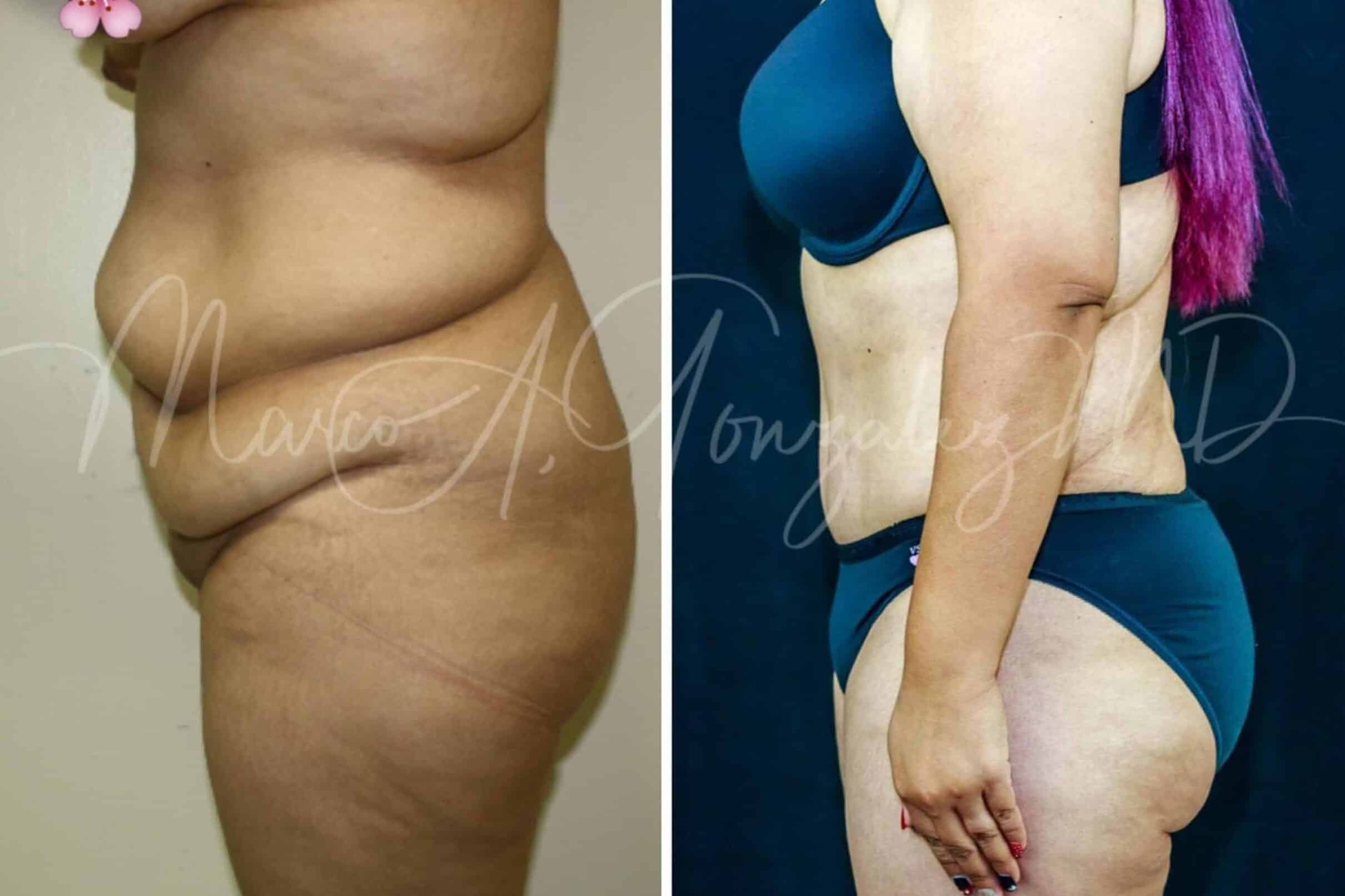 Case--6286 | After Laser 4D Hi-Def Liposculpting