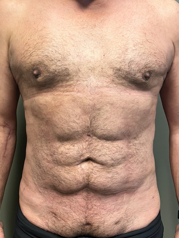 Case--5861 | After Laser 4D Hi-Def Liposculpting