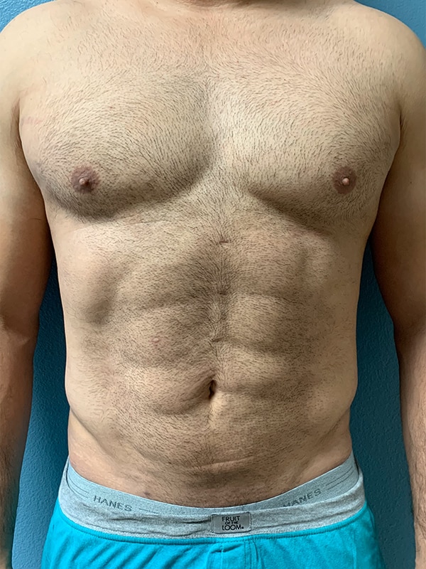 Case--5110 | After Laser 4D Hi-Def Liposculpting