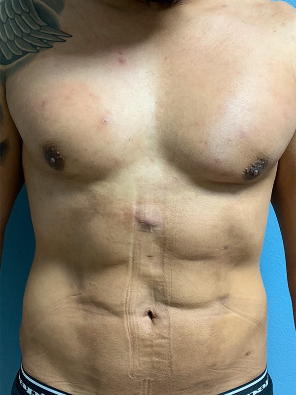 Case--6008 | After Laser 4D Hi-Def Liposculpting