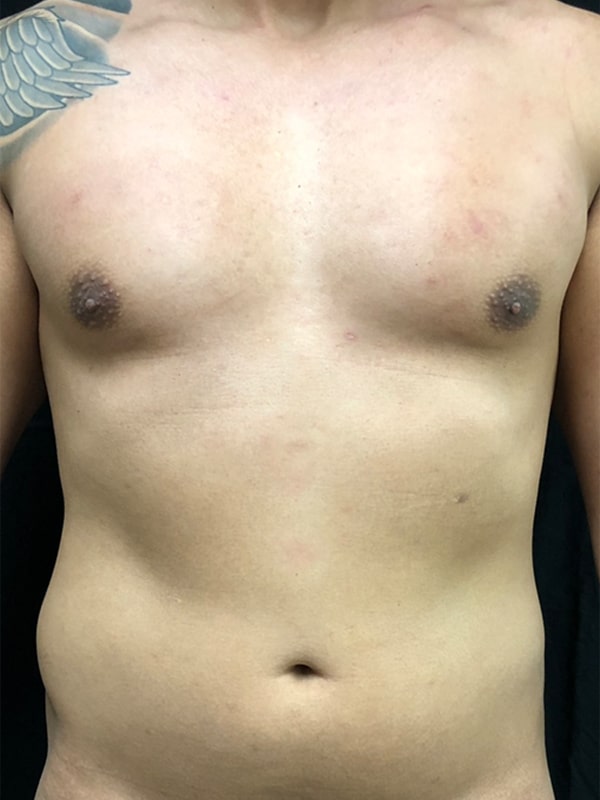 Case--6008 | Before Laser 4D Hi-Def Liposculpting