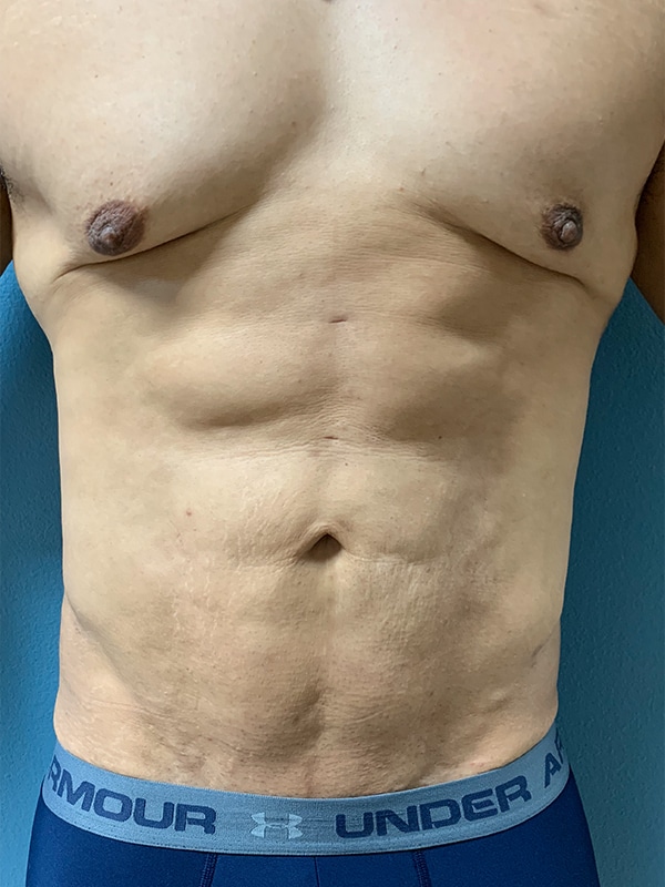 Case--4363 | After Laser 4D Hi-Def Liposculpting
