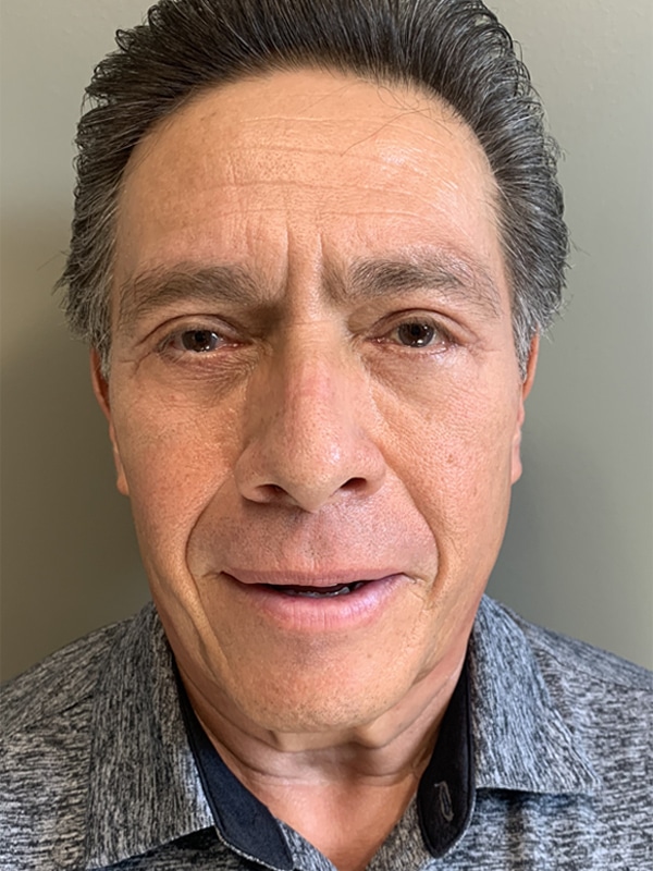 Case--2226 | After Eyelid Surgery