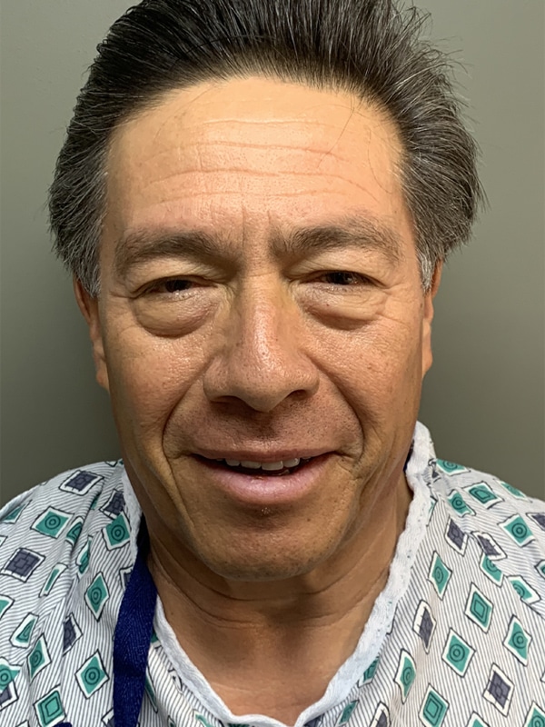 Case--2226 | Before Eyelid Surgery