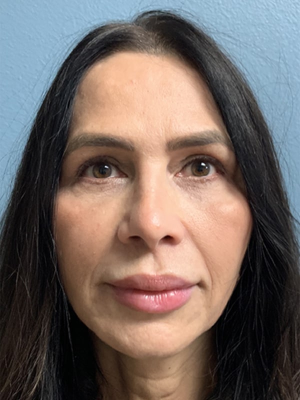 Case--6453 | After Eyelid Surgery