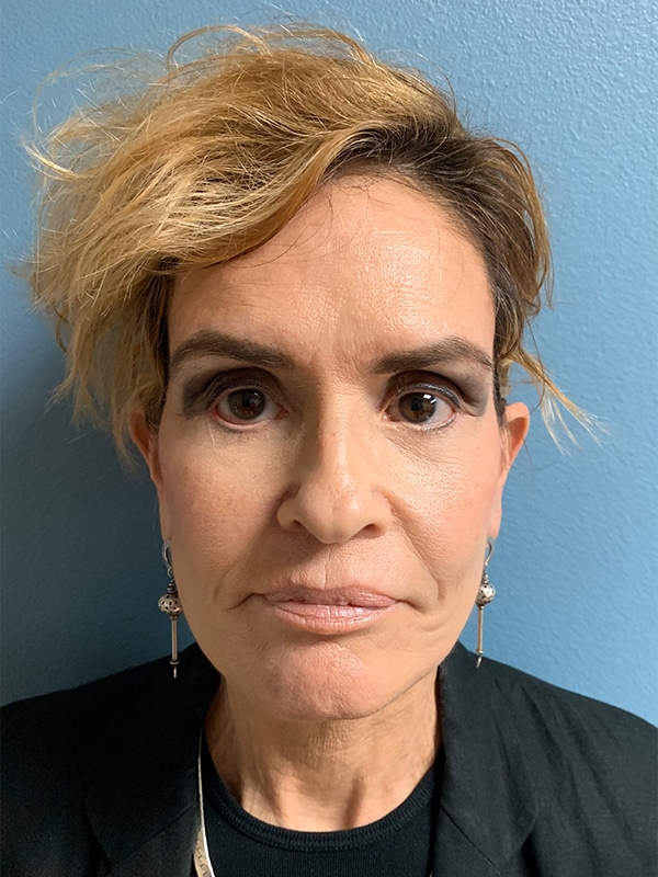 Case--7930 | After Facelift