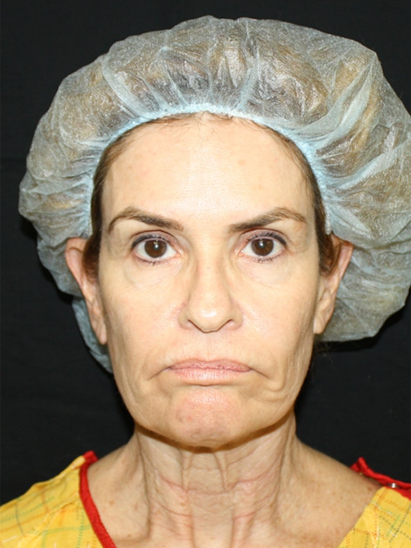 Case--7930 | Before Facelift