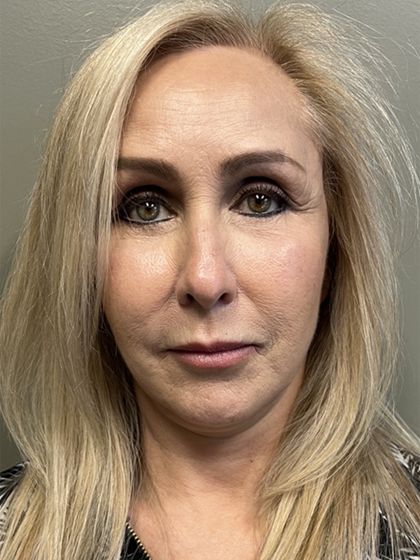 Case--9664 | After Eyelid Surgery