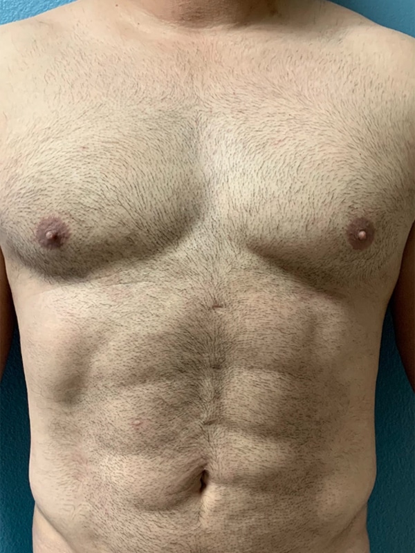 Case--1027 | After Body