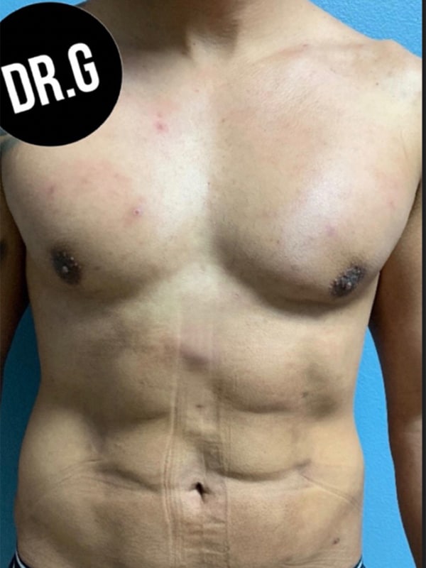 Case--1675 | After Body