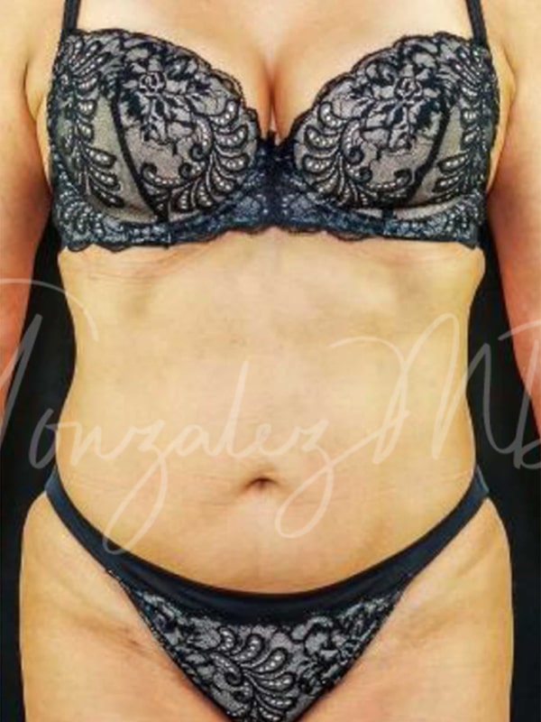 Case--4685 | After Body