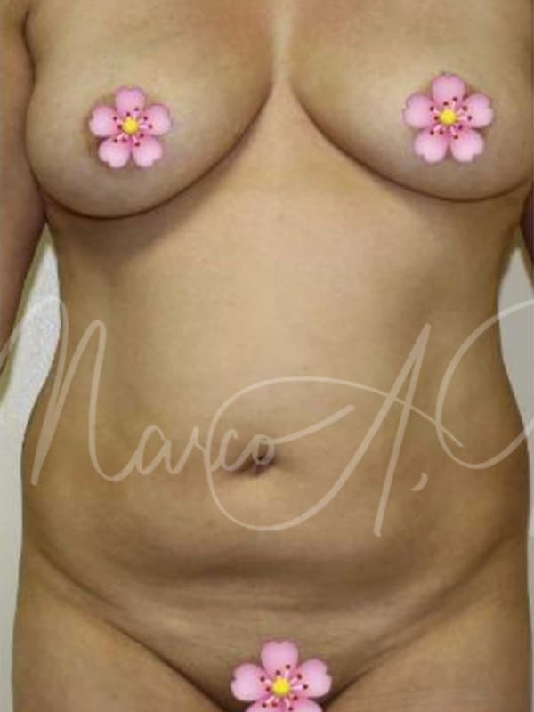 Case--4685 | Before Body